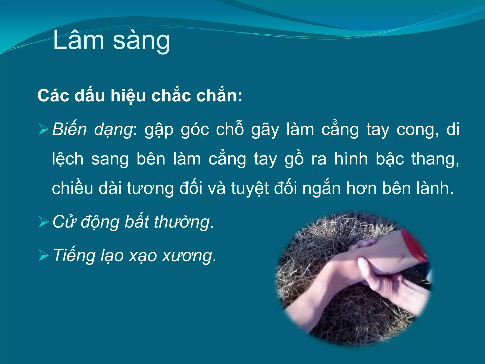 3 dấu hiệu chắc chắn gãy xương - Image 3