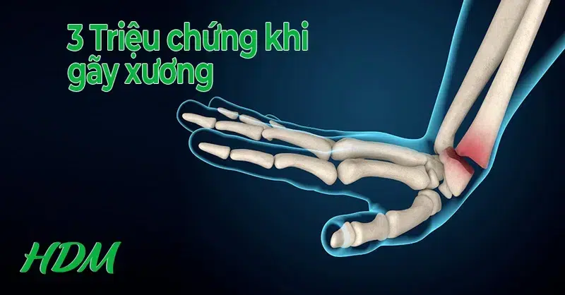 3 dấu hiệu chắc chắn gãy xương - Image 4
