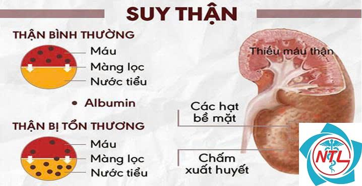 albumin niệu - Image 4