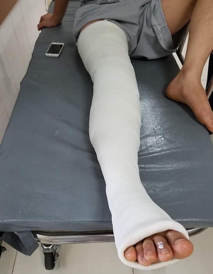 ảnh chân bó bột