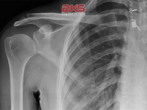 ảnh chụp x quang gãy xương vai
