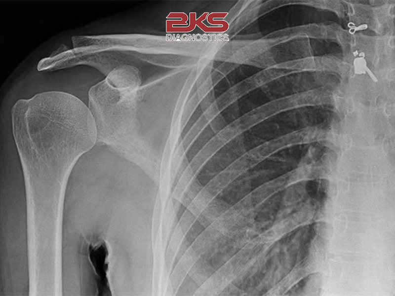 ảnh chụp x quang gãy xương vai