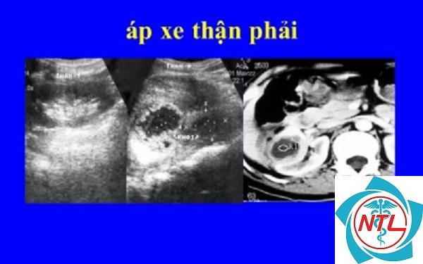 áp xe thận - Image 2