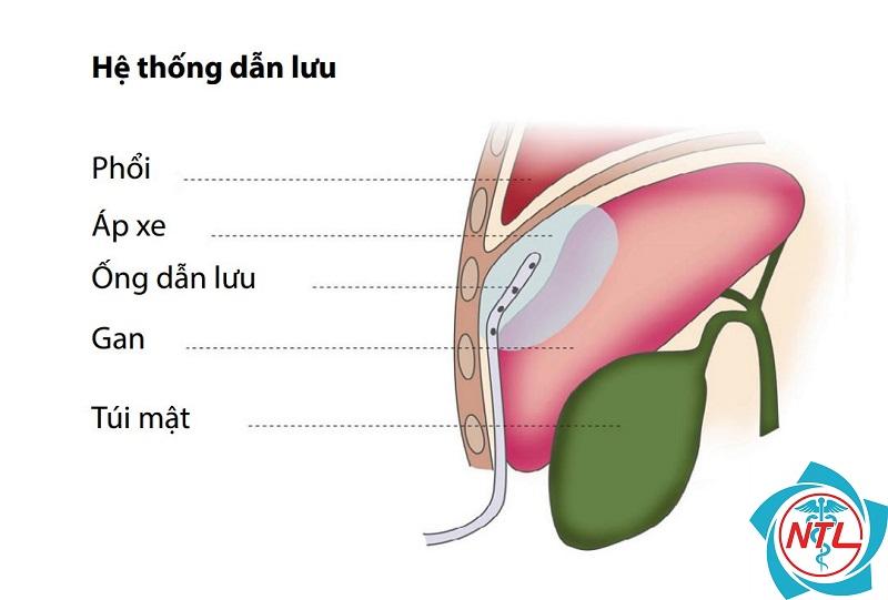 áp xe thận - Image 4