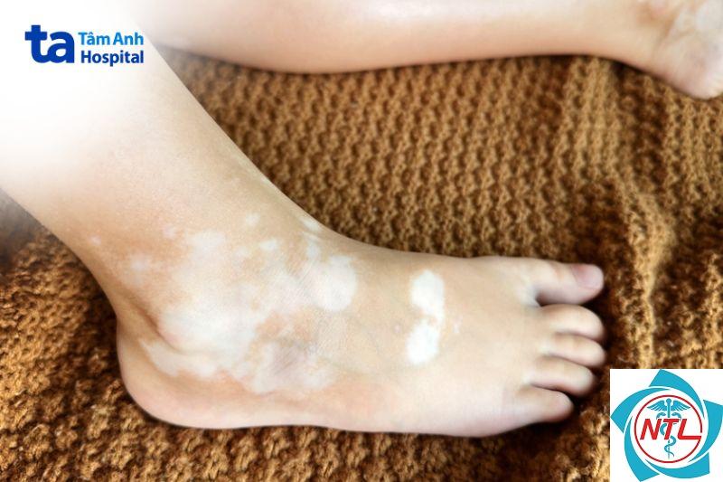 bạch biến ở bàn chân