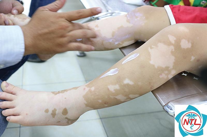 bạch biến ở trẻ nhỏ - Image 2