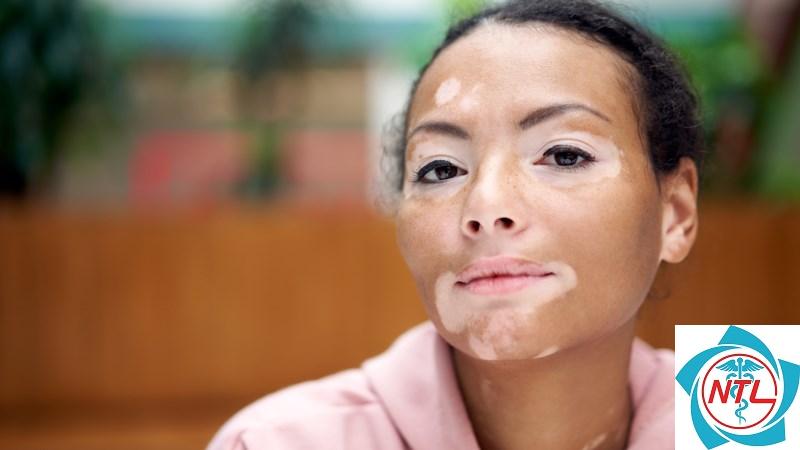 bạch biến quanh mắt - Image 3