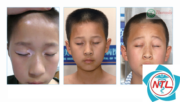 bạch biến quanh mắt - Image 4
