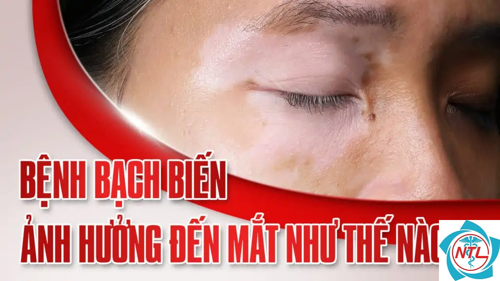 bạch biến quanh mắt