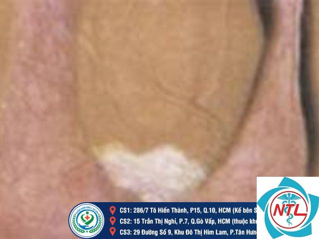 bạch biến vùng sinh dục - Image 4