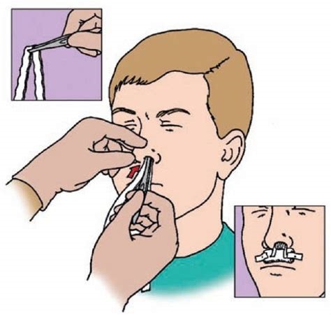 băng chèn được sử dụng cho vết thương nào - Image 4