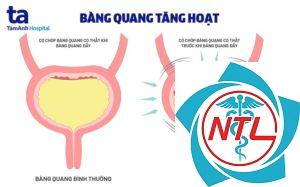 bàng quang hoạt động quá mức