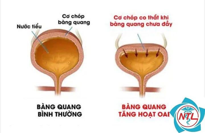 bàng quang tăng hoạt - Image 5