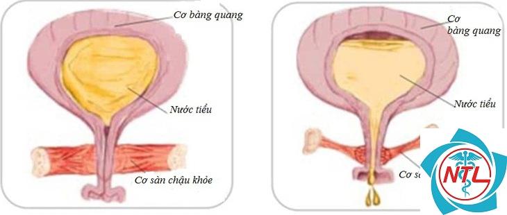 bàng quang tăng hoạt ở người cao tuổi - Image 2