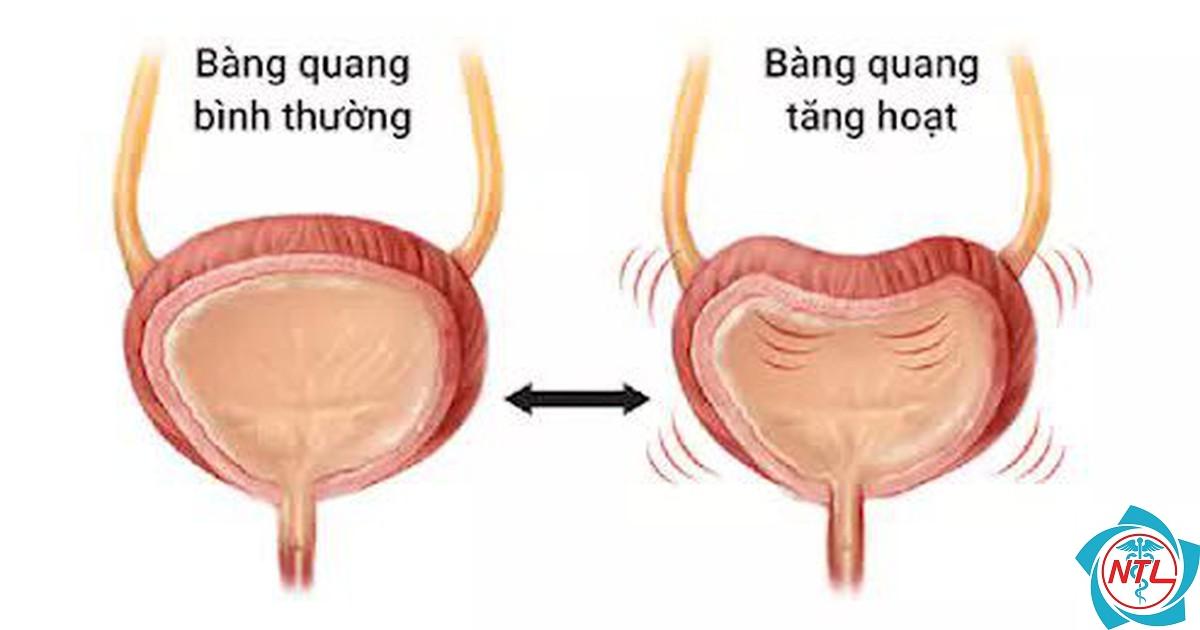 bàng quang tăng hoạt ở người cao tuổi - Image 3