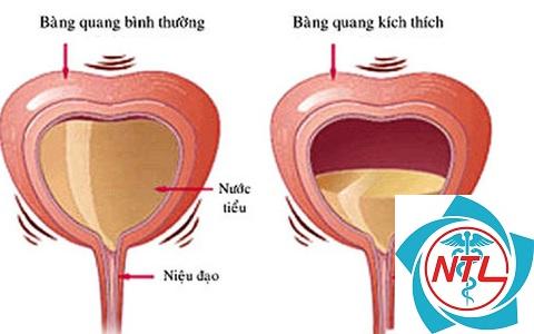bàng quang tăng hoạt ở trẻ em - Image 3