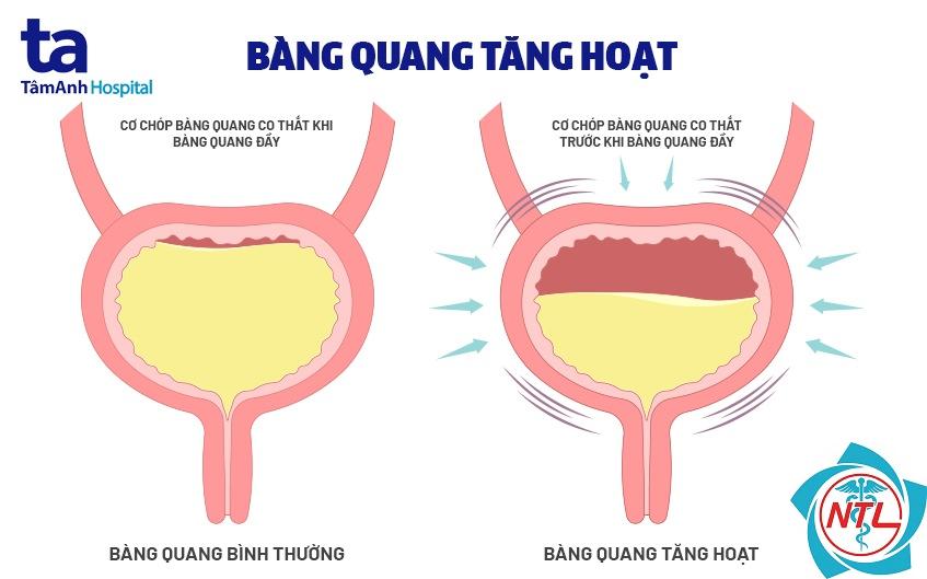 bàng quang tăng hoạt
