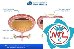 bàng quang thần kinh