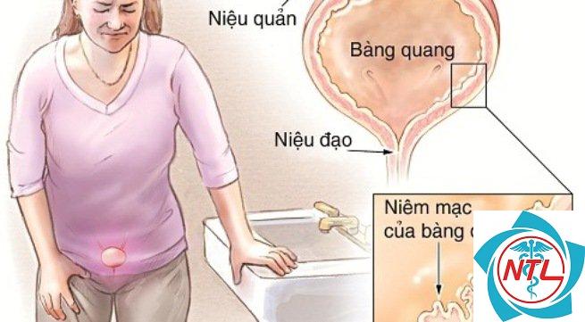 bàng quang thần kinh ở người lớn - Image 5