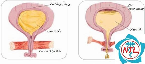 bàng quang thần kinh ở người lớn