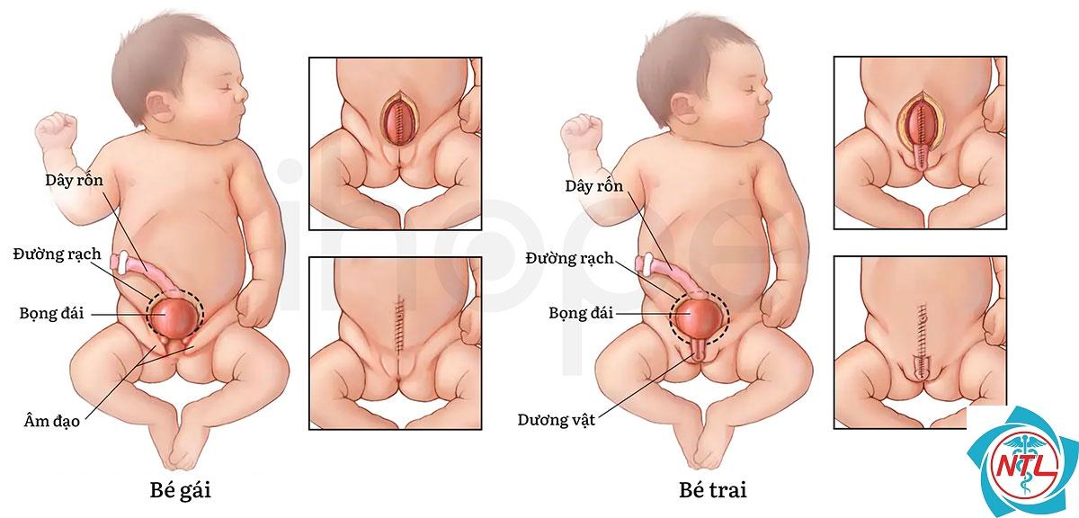bàng quang thần kinh ở trẻ em - Image 5