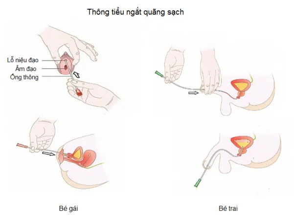 bàng quang thần kinh ở trẻ em