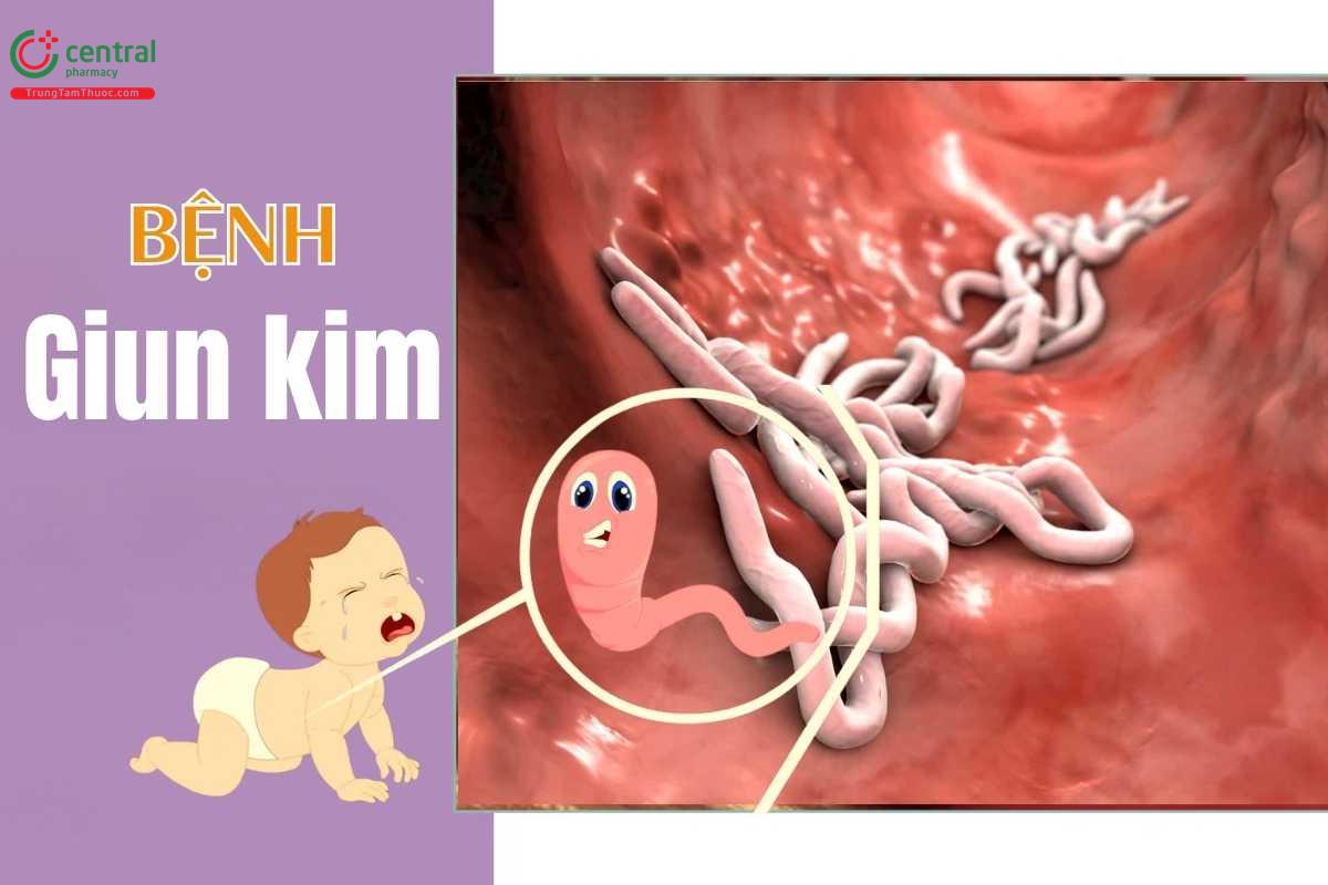 bé bị giun kim - Image 4