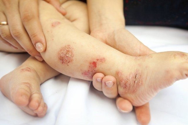 bé bị viêm da cơ địa