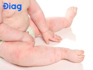 bé bị viêm da dị ứng
