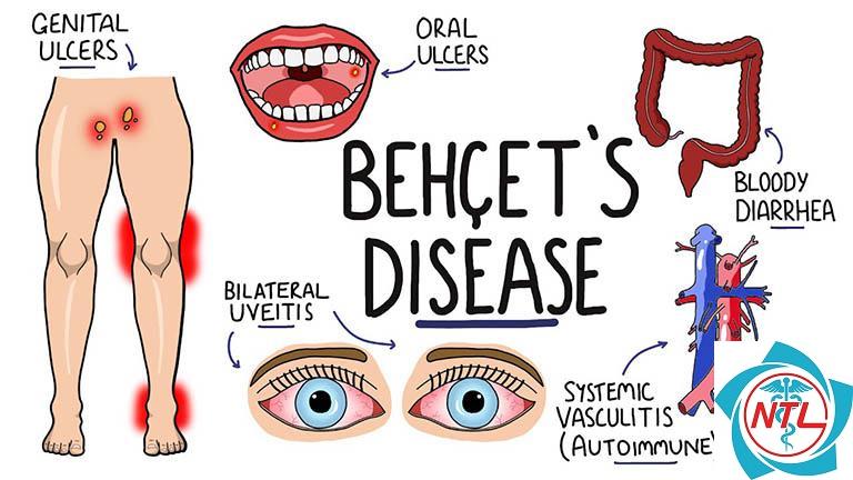 bệnh Behcet - Image 3