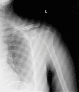 bệnh án gãy xương đòn - Image 3