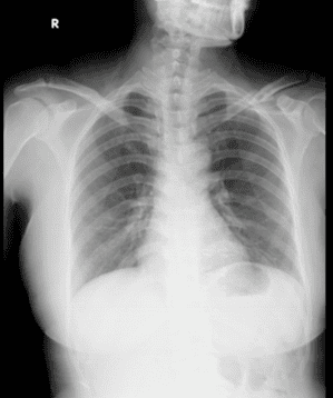 bệnh án gãy xương đòn - Image 4