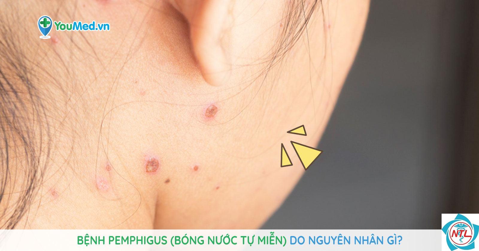 bệnh bóng nước tự miễn - Image 3