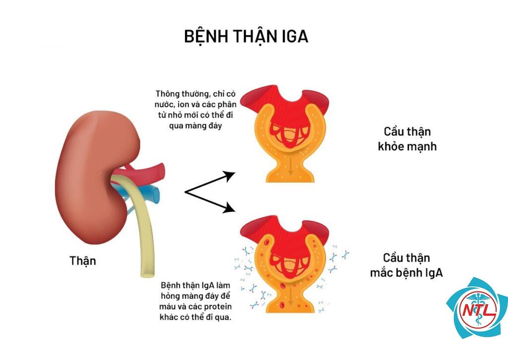 bệnh cầu thận IgA