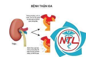 bệnh cầu thận IgA