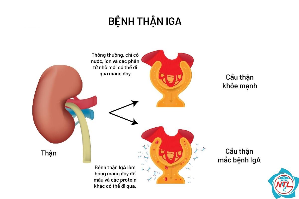 bệnh cầu thận IgA - Image 1