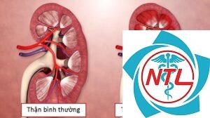 bệnh cầu thận màng