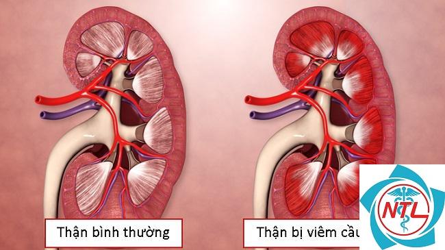 bệnh cầu thận màng