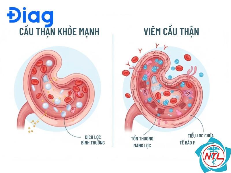 bệnh cầu thận