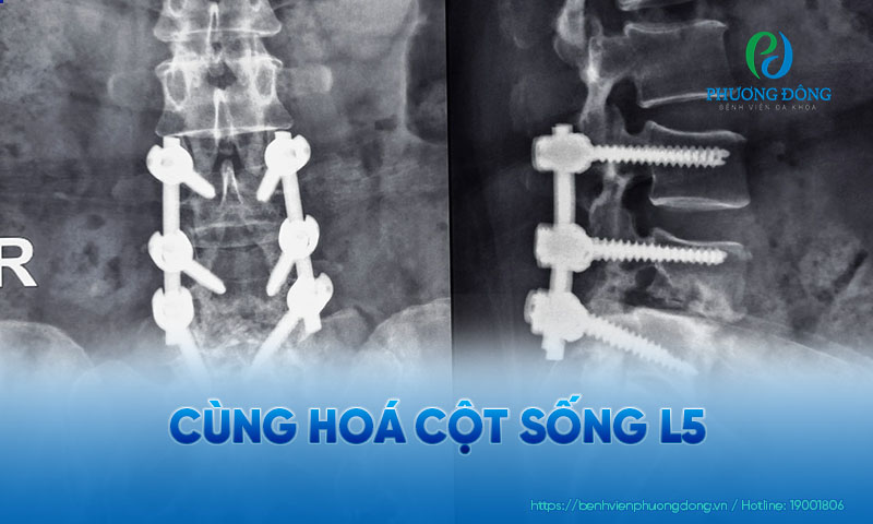 bệnh cùng hoá đốt sống - Image 2