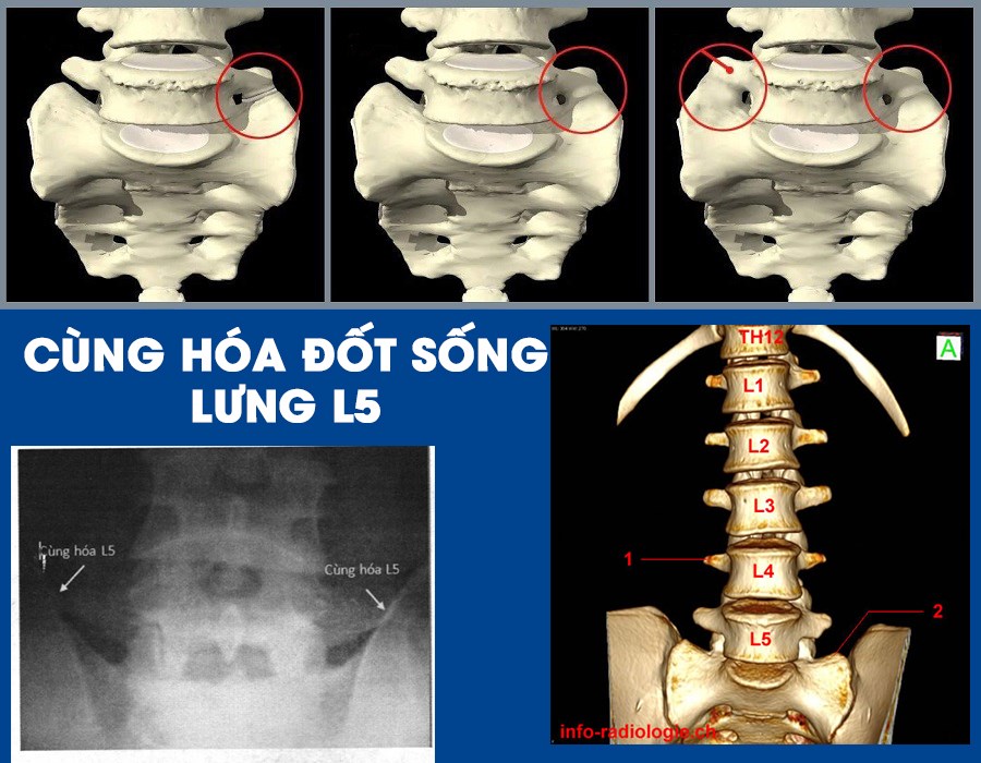bệnh cùng hoá đốt sống - Image 4