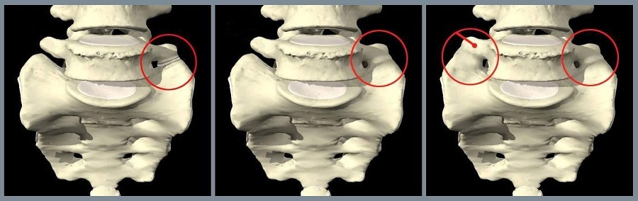 bệnh cùng hoá đốt sống