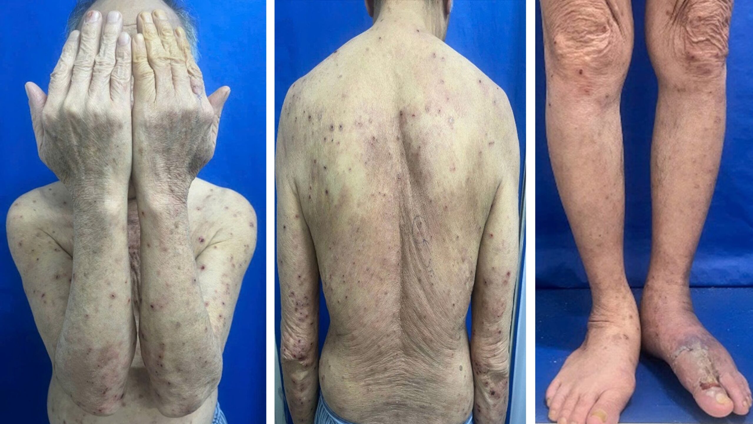 bệnh da bóng nước ở người cao tuổi - Image 2