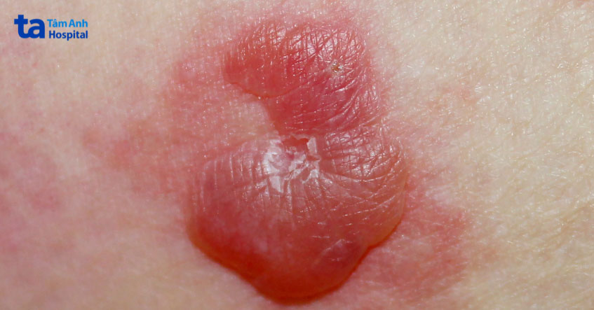 bệnh da bóng nước ở người cao tuổi - Image 4