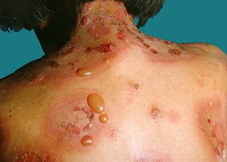bệnh da bóng nước ở người cao tuổi - Image 5