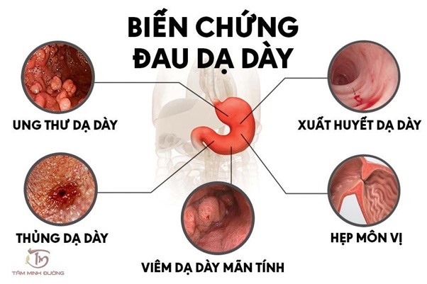 bệnh dạ dày - Image 3