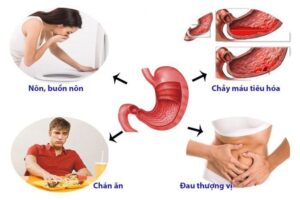bệnh dạ dày