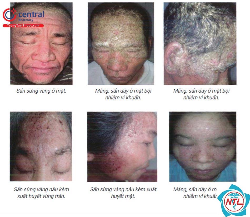 bệnh da di truyền ở người lớn - Image 2