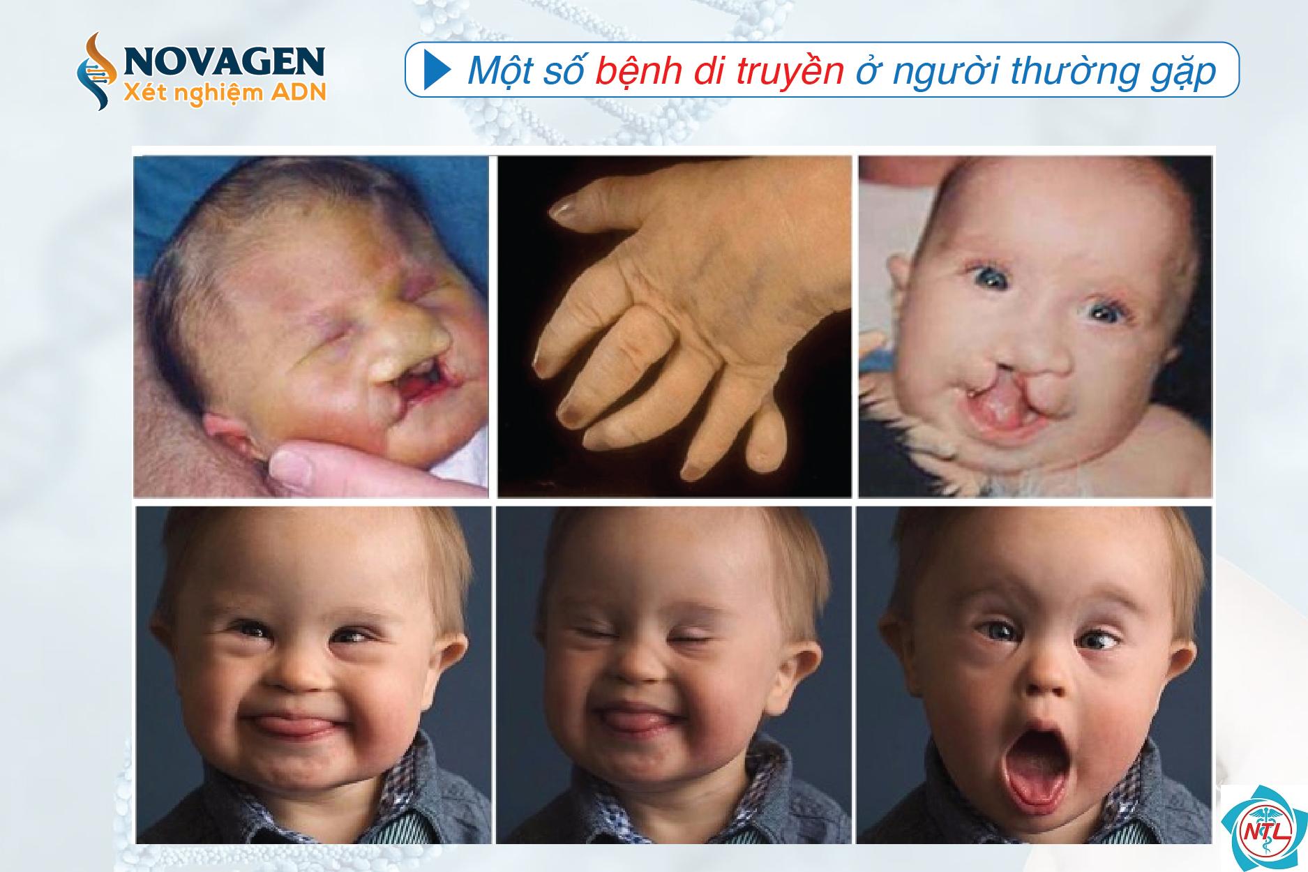 bệnh da di truyền ở người lớn - Image 4