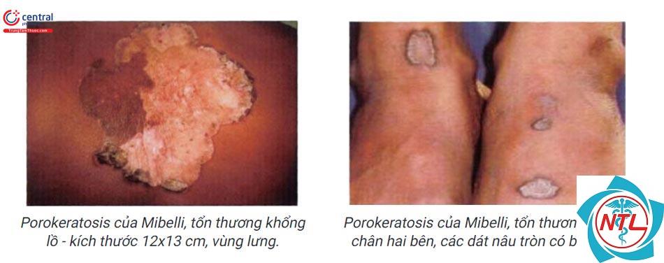 bệnh da di truyền ở người lớn - Image 5